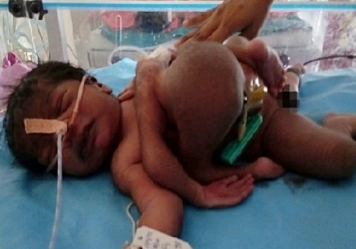 الطفل الحامل بجنين قبل اجرائه عملية جراحية
